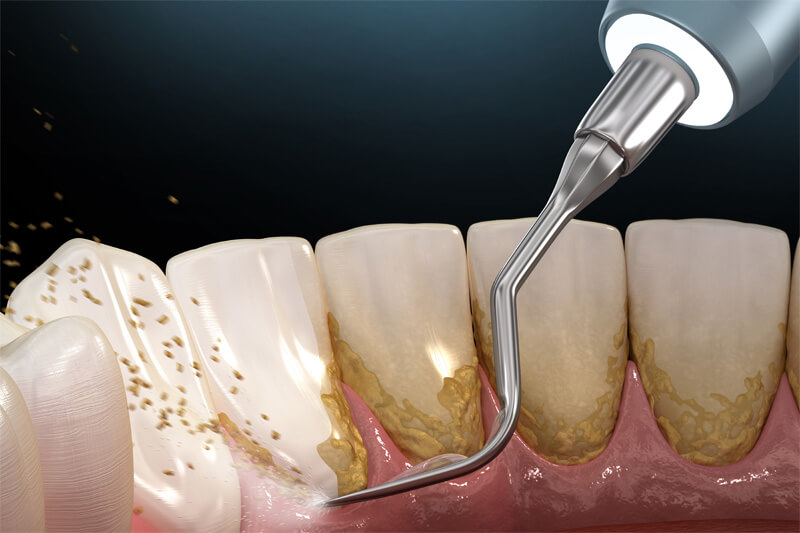 Regelmäßiges Entfernen von Plaque Zahnbelag sorgt für gesunde Zähne