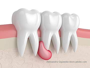 Zahnzysten - Arten, Symptome und Behandlung