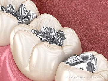 Zahnfüllungen aus Amalgam: Vor- und Nachteile, gesundheitliche Folgen & Alternativen