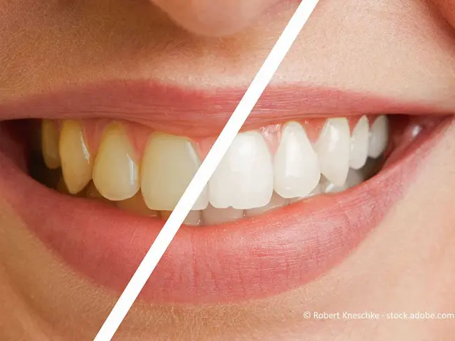 Vergleich von Zähnen vor und nach einem Zahnbleaching