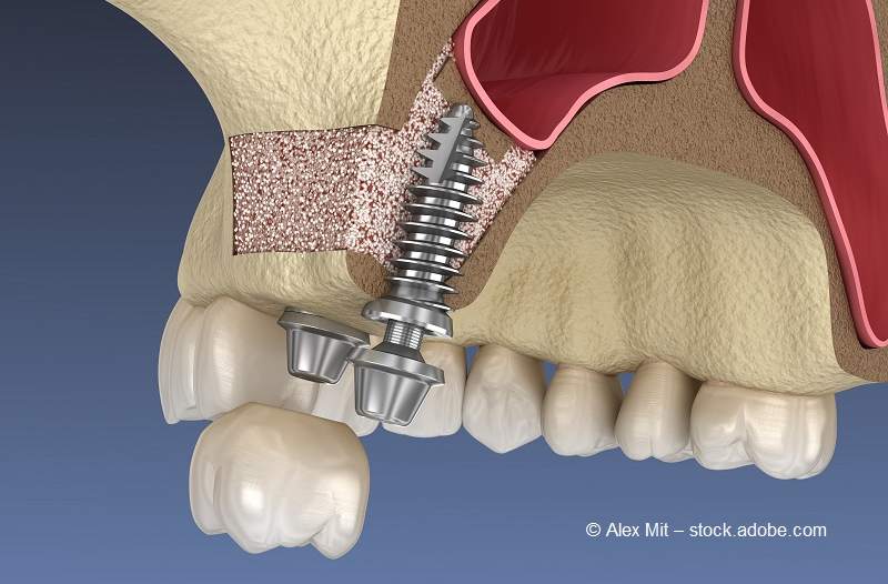 Der Kieferknochen wurde mit Material aufgefüllt und ein Implantat darin befestigt.