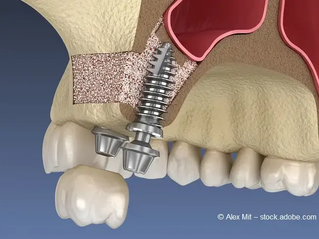 Der Kieferknochen wurde mit Material aufgefüllt und ein Implantat darin befestigt.