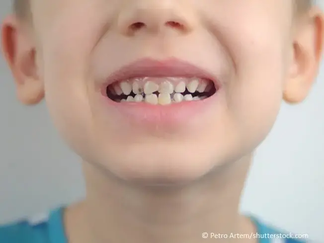 Kreidezähne Kreidezähne -Porträt eines kleinen Jungen mit schlechten Zähnen