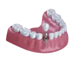 3D-Illustration Gebiss mit Implantat -Zahnzusatzversicherung Münchener Verein