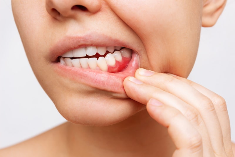 Gerötetes oder blutendes Zahnfleisch kann ein Anzeichen für eine Zahnfleischentzündung sein.