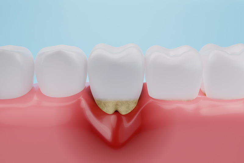 Zahnfleischschwund kann sich durch Blutungen und freiliegende Zahnhälse äußern.