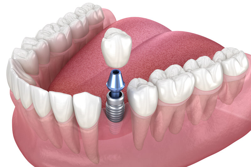 Bei einem Implantat wird eine künstliche Zahnwurzel im Kiefer befestigt, an welcher der Zahnersatz angebracht wird.